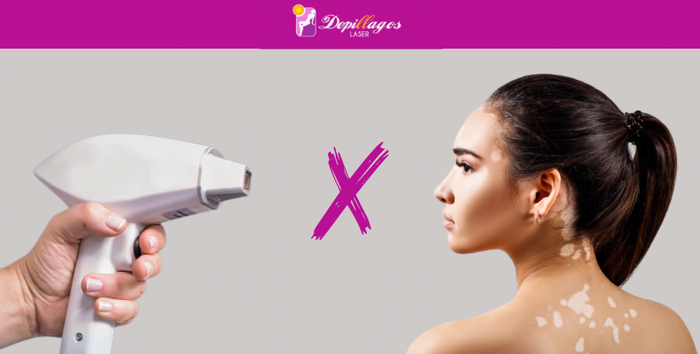 Vitiligo : É possível fazer depilação definitiva a Laser?